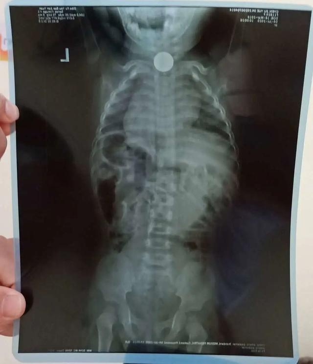 警惕,淄博近期已多起!孩子只有1岁,被紧急抢救,都是因为… 警惕,淄博近期已多起!孩子只有1岁,被紧急抢救,都是因为…